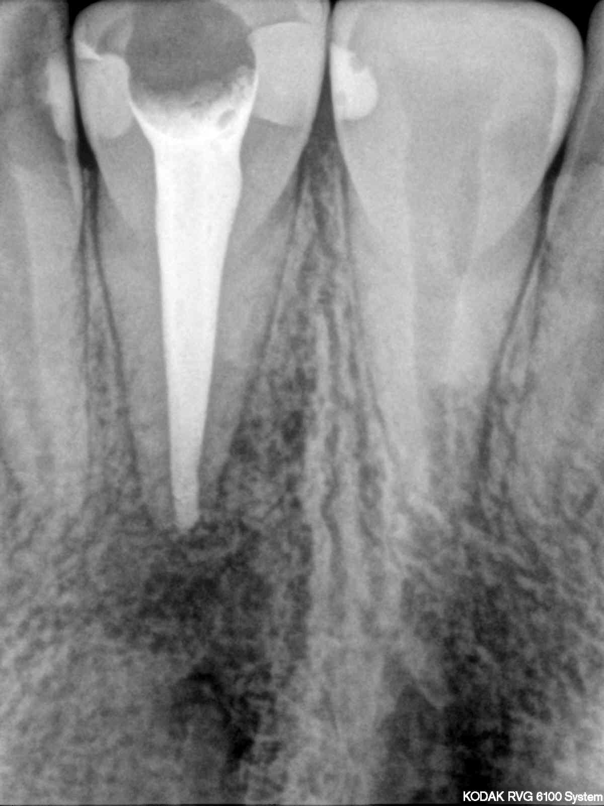 Пульпит 17 зуба рентген с запломбированными каналами